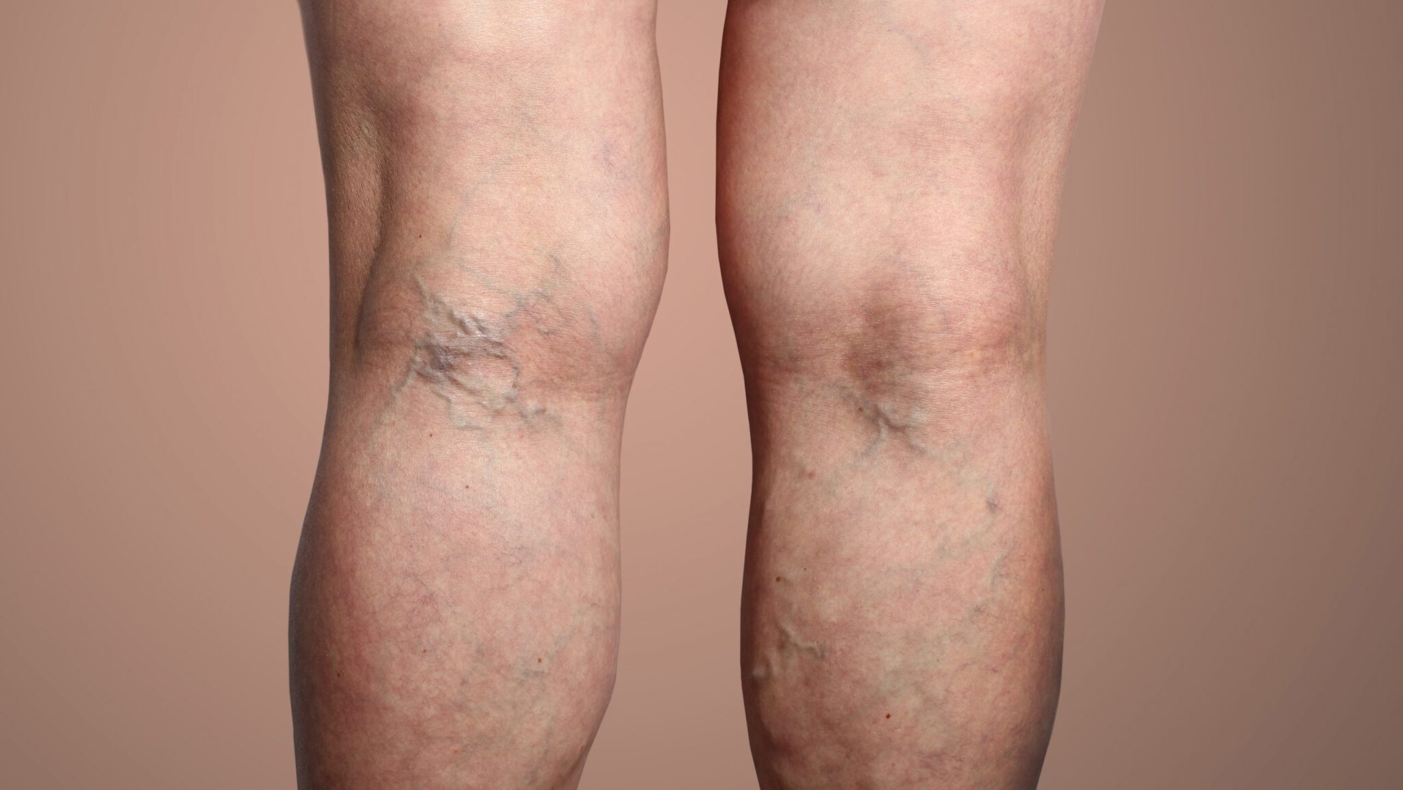 Varicose Veins vs. Spider Veins: What’s the Difference? - Renew Veins